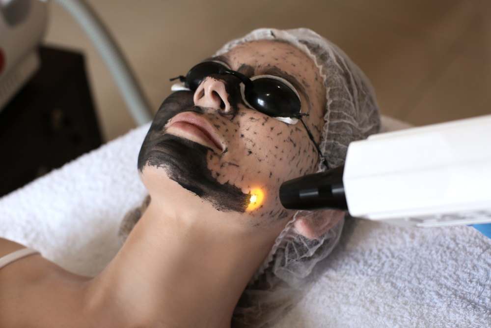 How Long Do Laser Carbon Peel Results Last