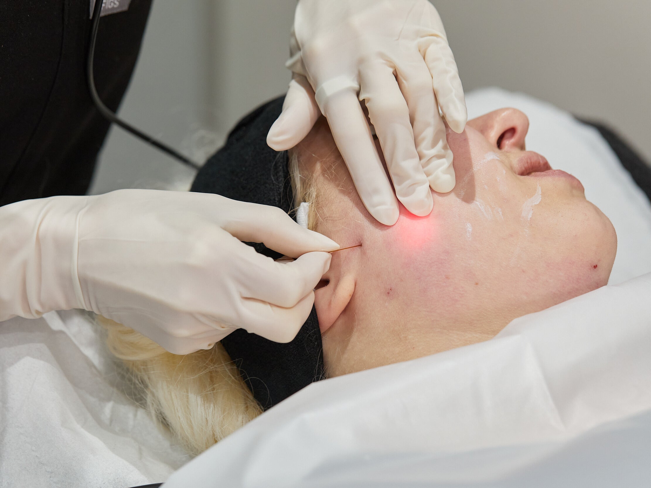 What Makes Endolift a Popular Non-Surgical Option